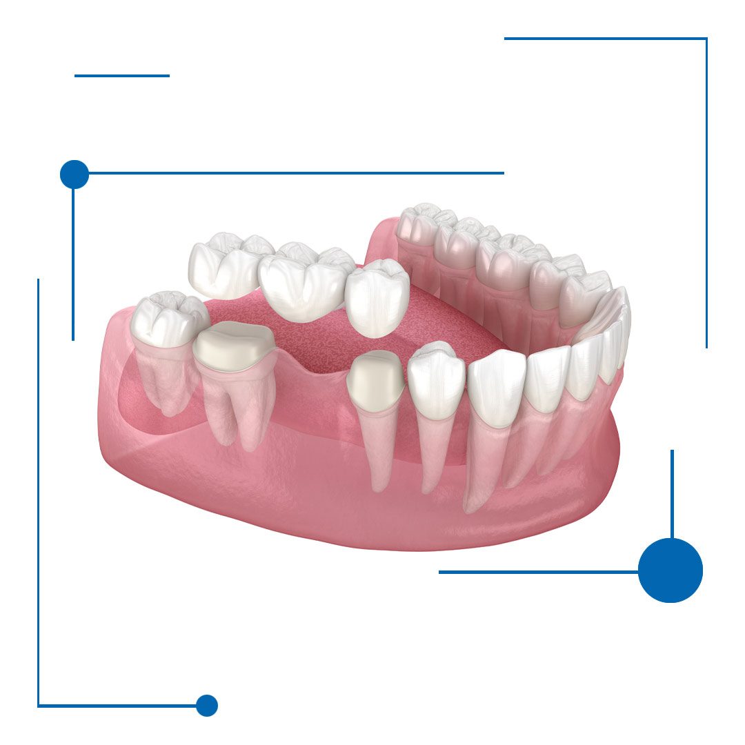 Best Dental Bridges in Houston, Texas