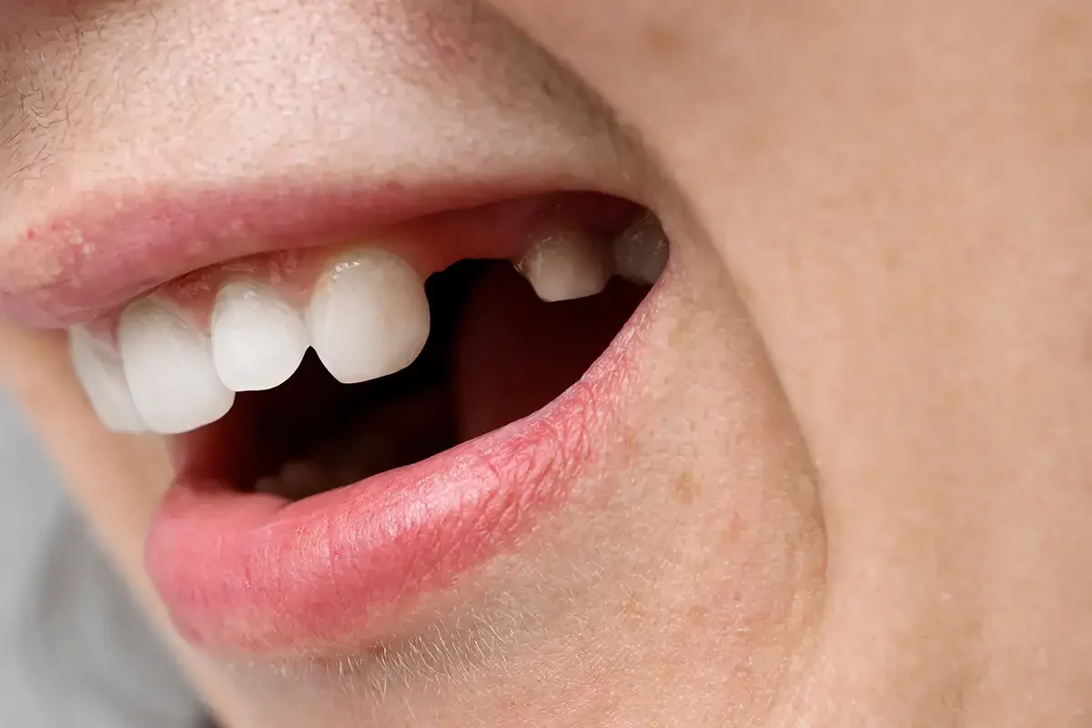 Close-up of woman's teeth after dental extractions