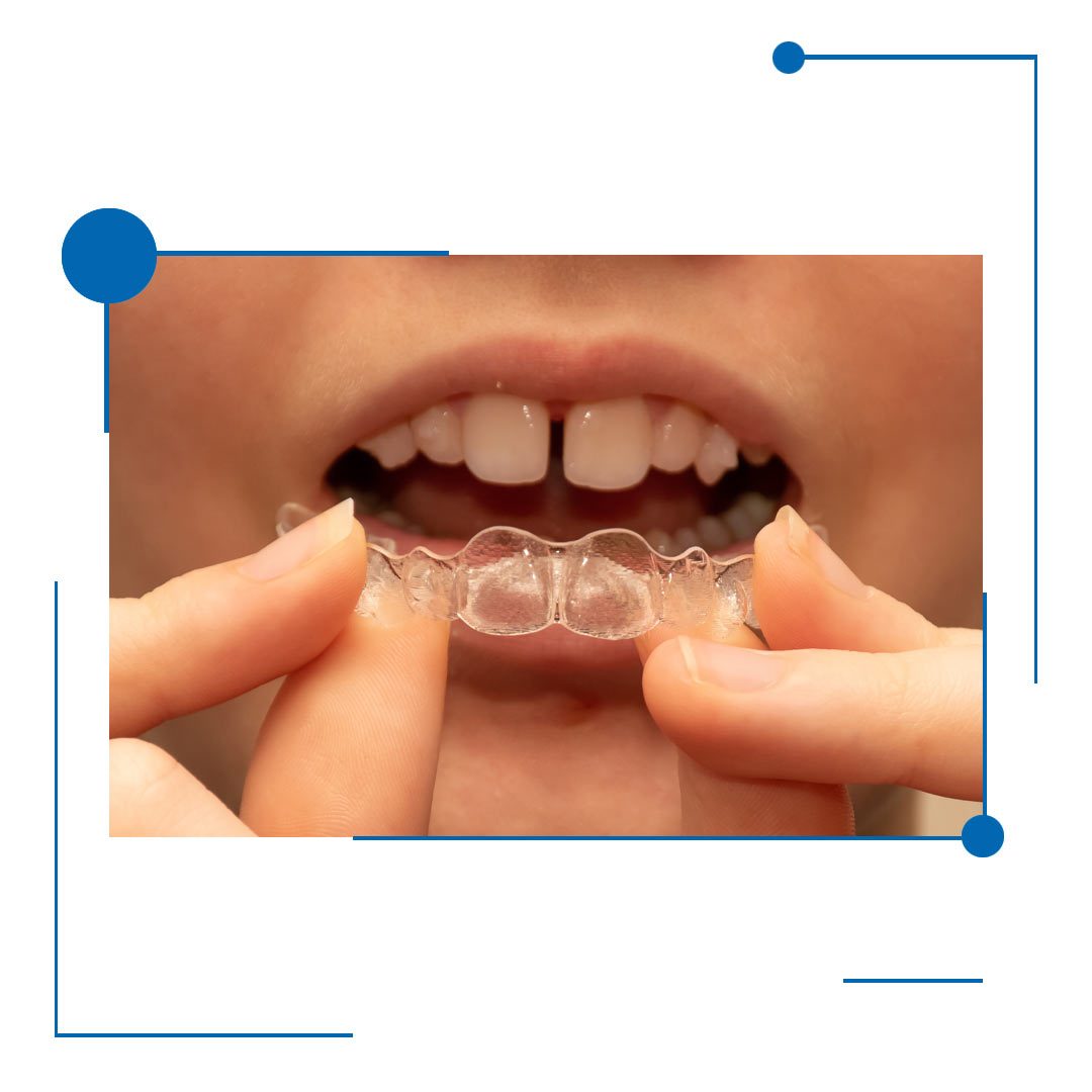 Ideal Clear Aligners in Houston, Texas