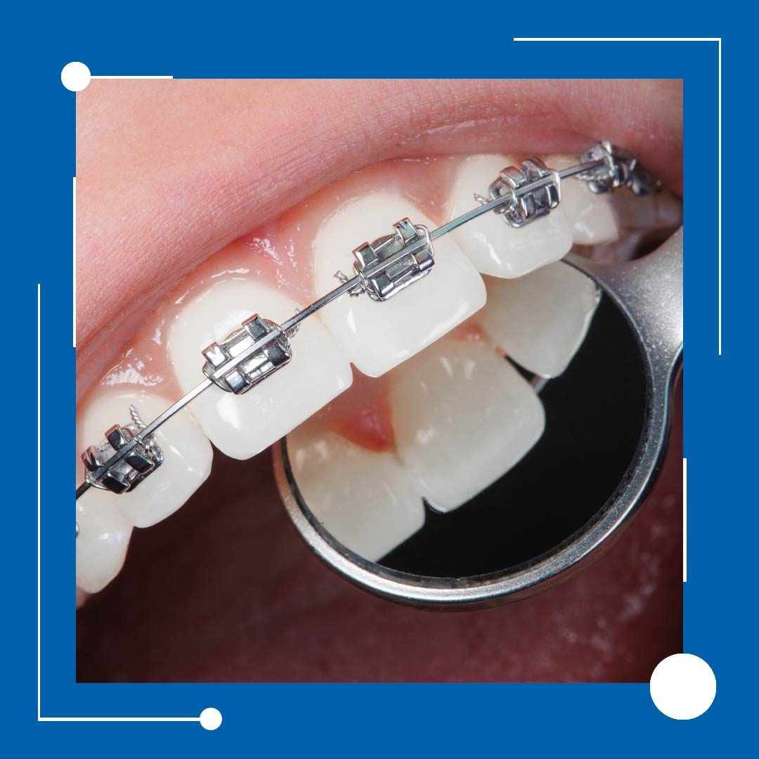 Perfect Kids Braces in Houston, Texas