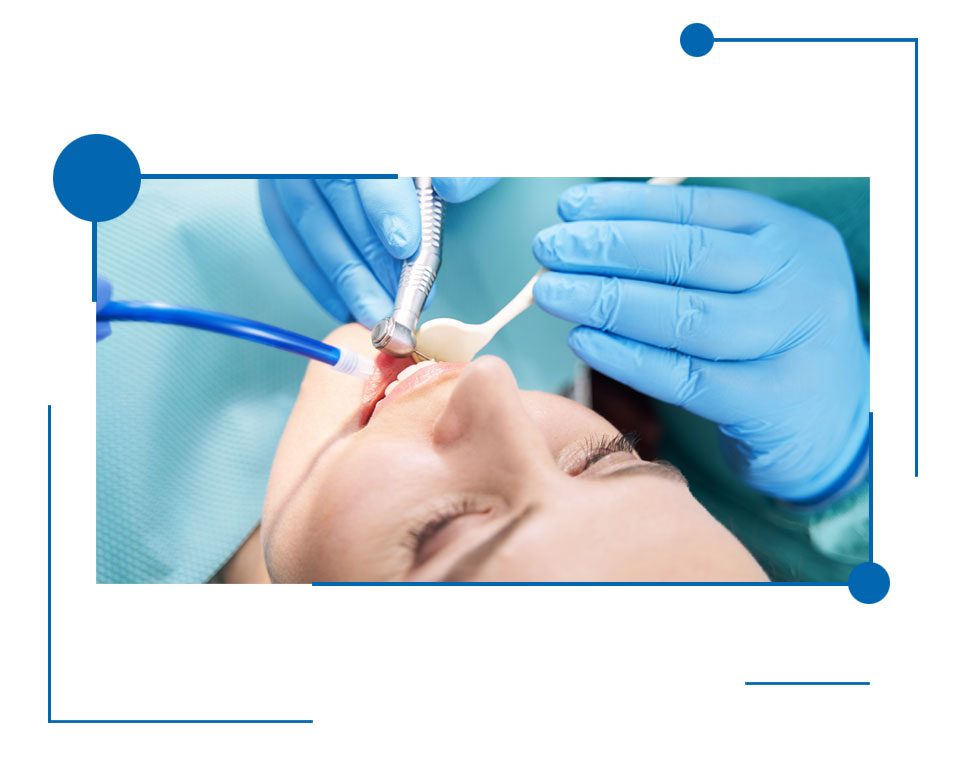 Professional Root Canal Therapy in Houston, Texas