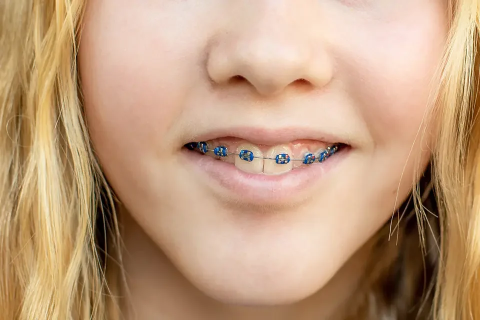 blue brackets Popular Braces Colors for Girls