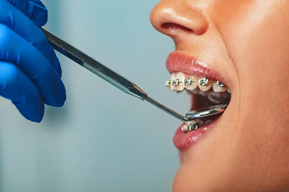 braces examination What are Headgear Braces?