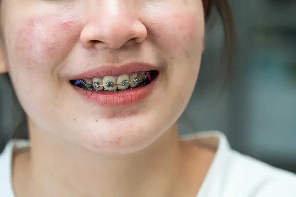 braces for teenagers Causas de las Infecciones Dentales