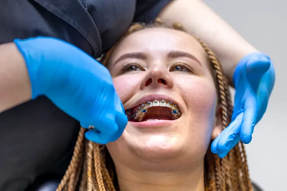 braces installment How Do Porcelain Braces Work?