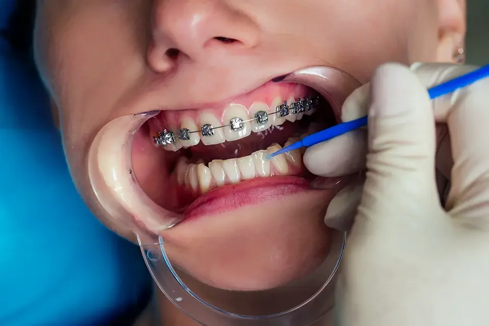 braces treatment Cómo usar hilo dental con brackets