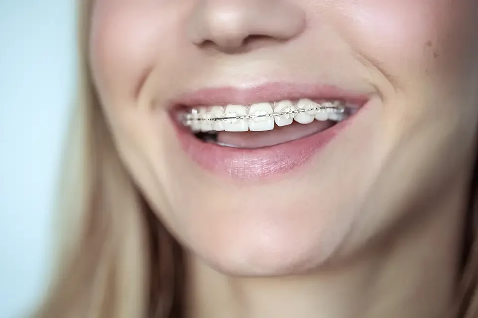 clear braces for adults What are Clear Braces for Adults?