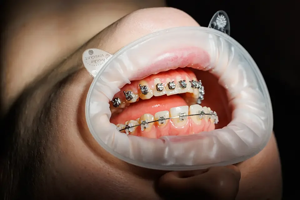 Ceramic Braces in Houston