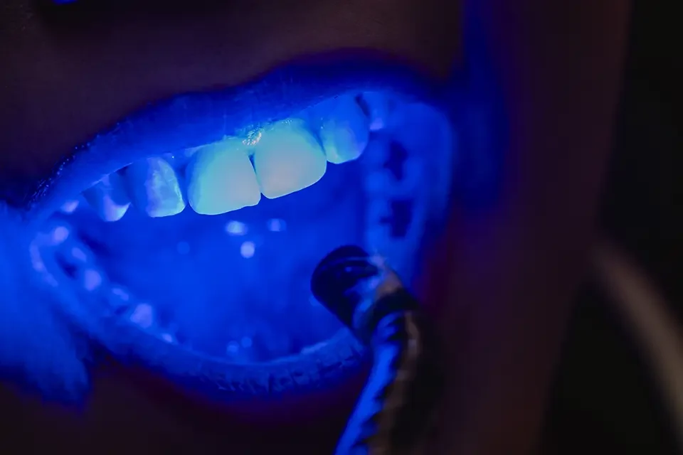 What Are Lumineers and How Do They Work?