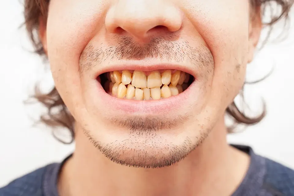 close-up-portrait-smile-teeth-man-yellow teeth Signs of Rotten Teeth