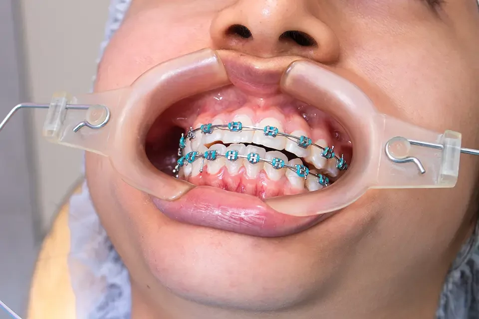 What Are Tooth-Colored Braces?