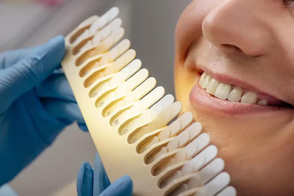 What Are Zirconia Veneers?