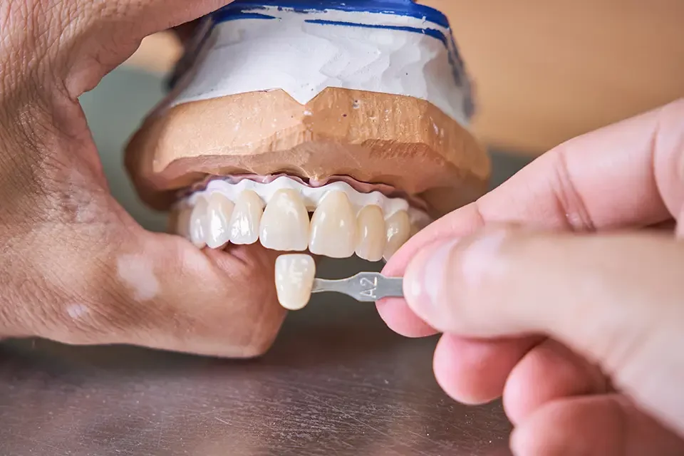 crown color choosing Beneficios de las Coronas Dentales el Mismo Día en su Duración