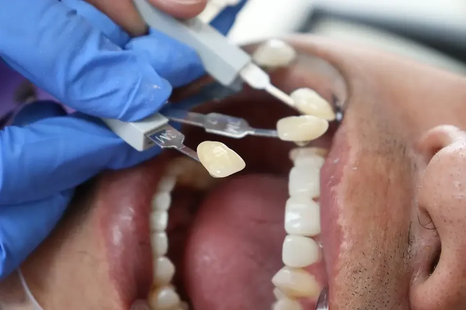crown procedure How to Use Dental Crown Glue (Temporary Repairs)