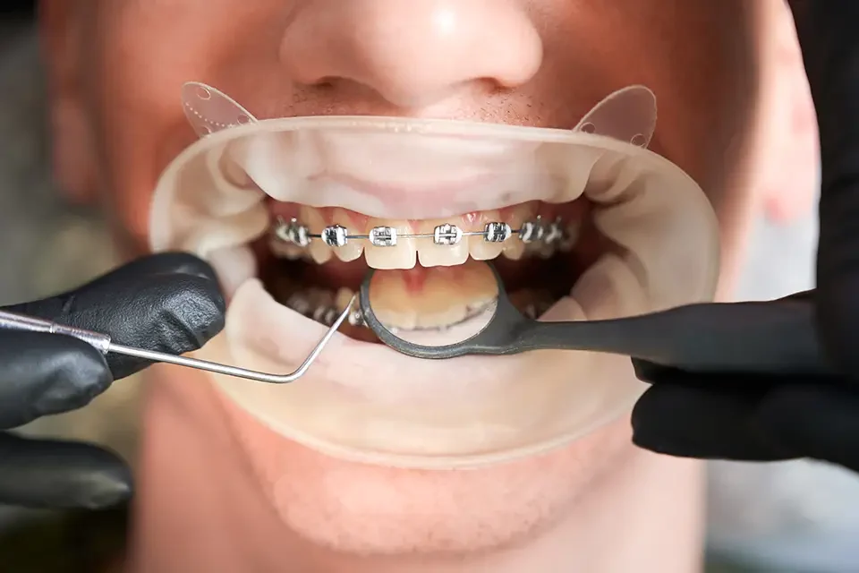 dental braces examination ¿Qué son los Frenillos Transparentes para Adultos?