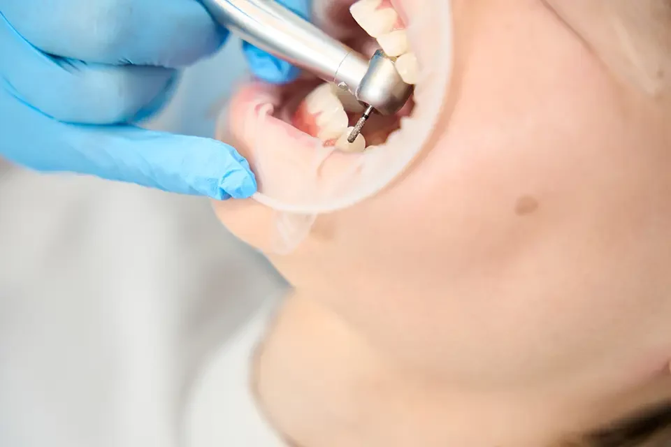 dental drilling Step-by-Step Dental Crowns Procedure