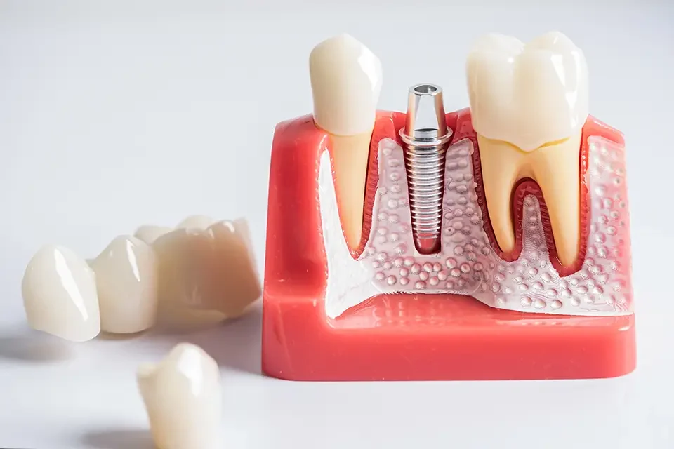 dental-implant-artificial-tooth-roots What Are Same day Dental Implants?