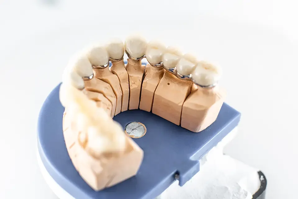 Alternatives to Cantilever Dental Bridges