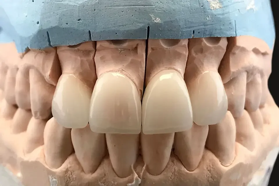 What Is a Dental Crown for a Front Tooth?