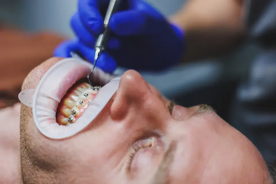 What Are Ceramic Braces?
