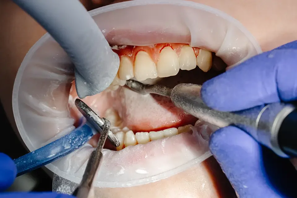 The Importance of Dental Restoration