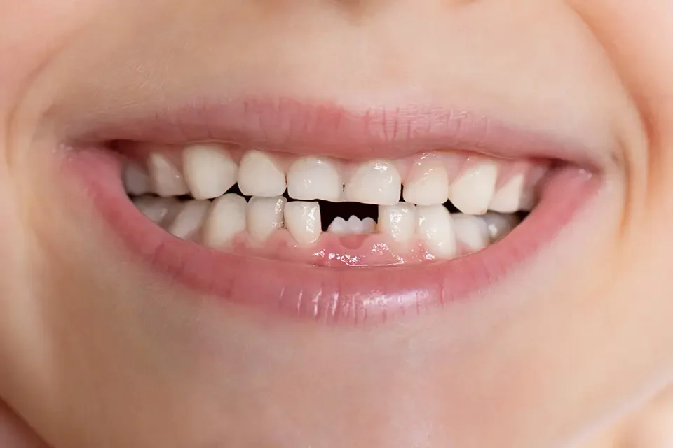 Your Best Solutions for a Missing Front Tooth