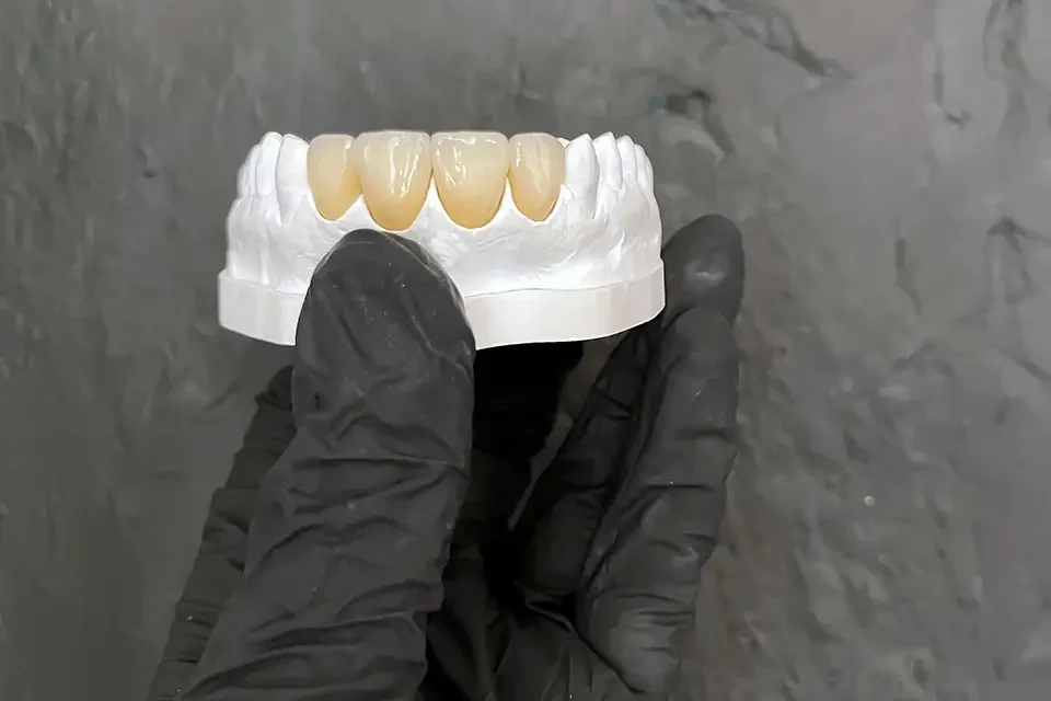front teeth dental crowns Costo de una Corona Dental en un Diente Frontal