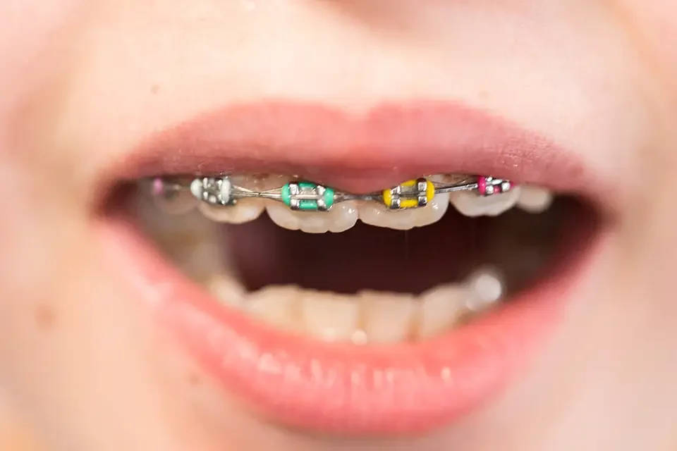 Tooth-Colored Braces Cost
