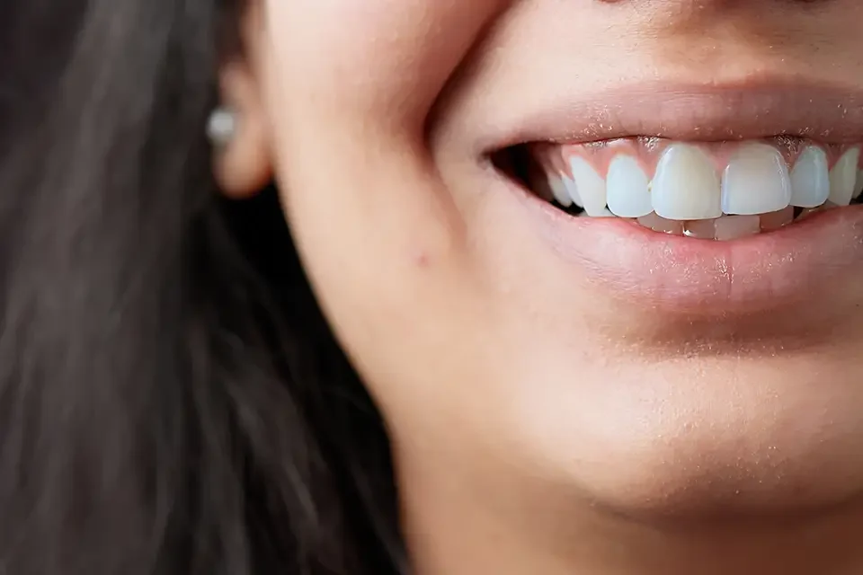 macro-shot-of-authentic-smile-with-white-teeth Understanding Front Tooth Crowns: What Are They?
