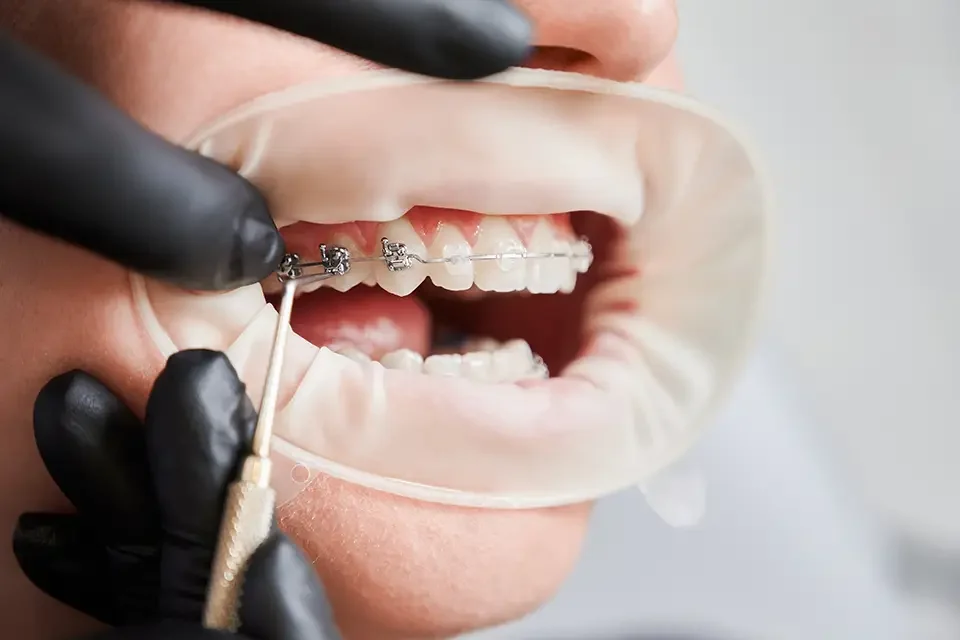 Types of Braces Cost