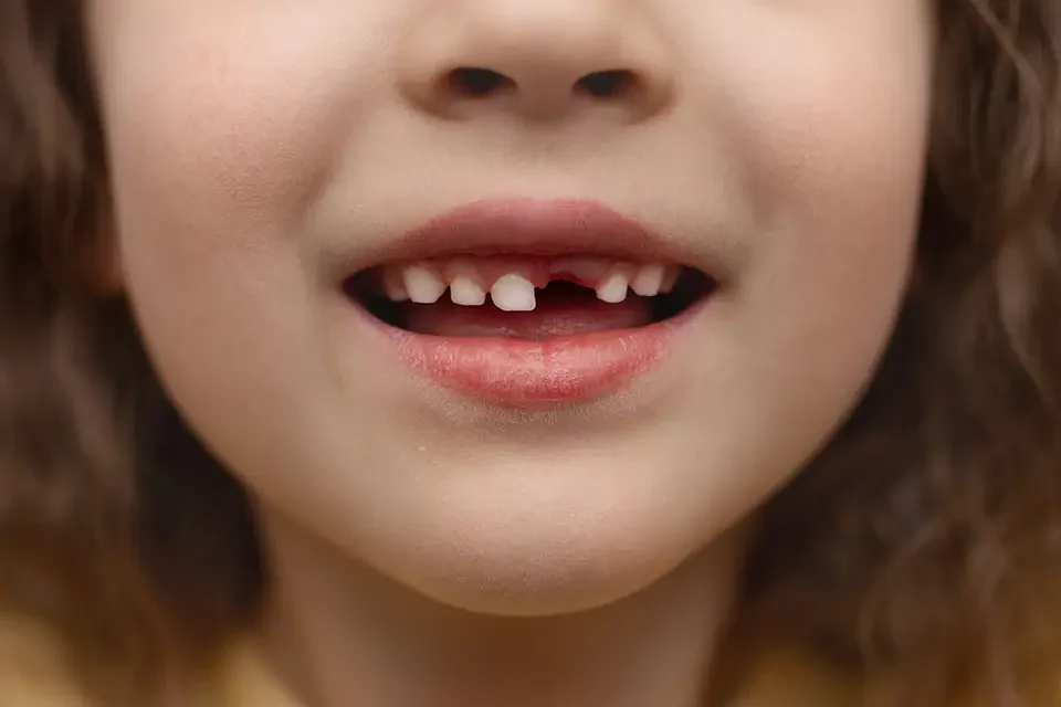 How to Choose the Best Treatment for a Missing Front Tooth