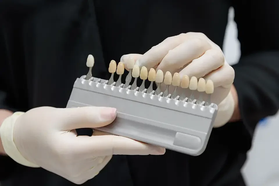 What Are Emax Veneers?