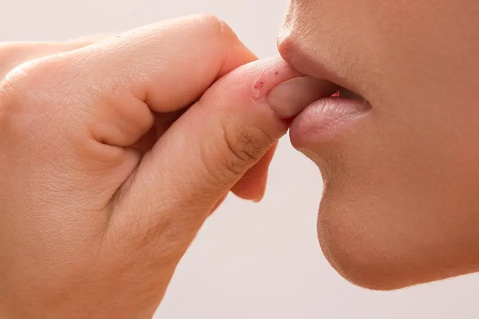 thumb sucking Effects of Thumb Sucking on Dental Health