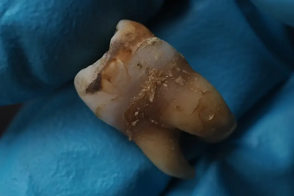 tooth decay Why Is a Wisdom Tooth Cavity So Common?