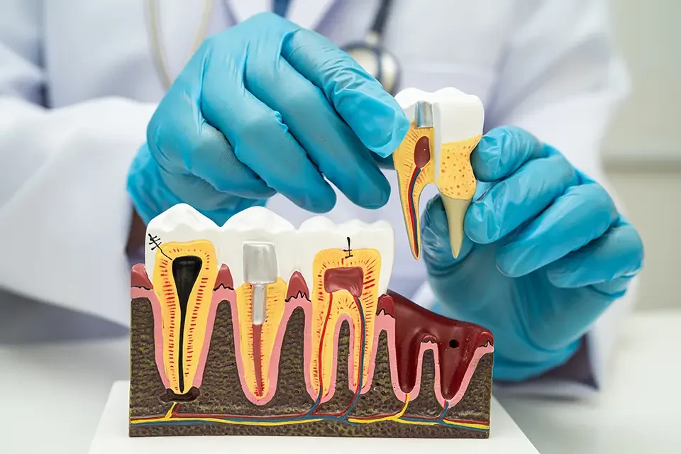 tooth model roots Symptoms of a Tooth Needing a Root Canal Treatment